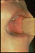 Rougeole5T.gif (4174 octets)