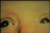 Rubeole_Cong_2T.gif (2221 octets)
